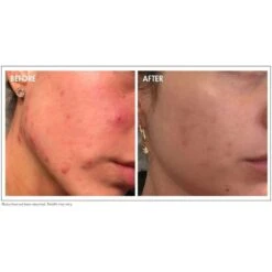 GLOWBIOTICS MD Probiotic Acne Treatment Cleanser (5 Fl Oz / 150 Ml) -PureVita Store GLMV180949 BA