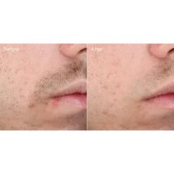 Murad Outsmart Acne Clarifying Treatment (Acne Control) (1.7 Fl Oz / 50 Ml) -PureVita Store MURV187326 BA2