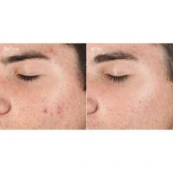 Murad Outsmart Acne Clarifying Treatment (Acne Control) (1.7 Fl Oz / 50 Ml) -PureVita Store MURV187326 BA3