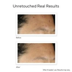 Murad Invisiscar Resurfacing Treatment (Acne Control) (1 Fl Oz / 30 Ml) 10 Murad Invisiscar Resurfacing Treatment (Acne Control) (1 Fl Oz / 30 Ml) -PureVita Store MURV189760 BA2