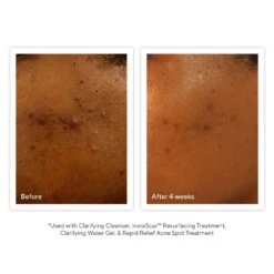 Murad Clarifying Cleanser (Acne Control) (13.5 Fl Oz / 400 Ml) -PureVita Store MURV190403 BA2