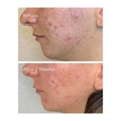 Murad AHA/BHA/Retinoid Daily Clarifying Peel (Acne Control) (95 Ml / 3.2 Fl Oz) -PureVita Store MURV190425 BA2