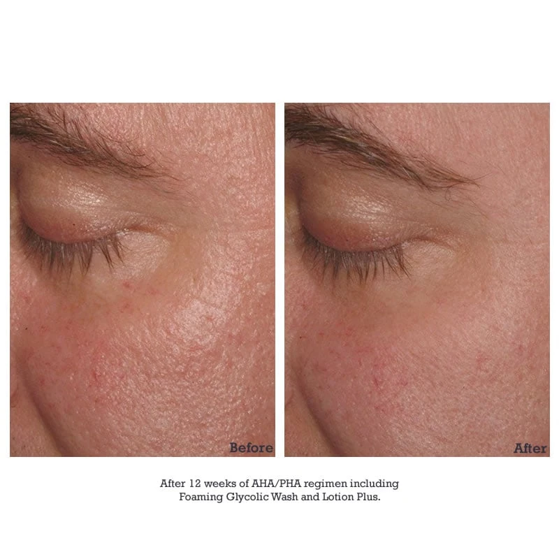 NEOSTRATA Lotion Plus (RESURFACE) (200 Ml / 6.8 Fl Oz) 5 NEOSTRATA Lotion Plus (RESURFACE) (200 Ml / 6.8 Fl Oz) - Image 3