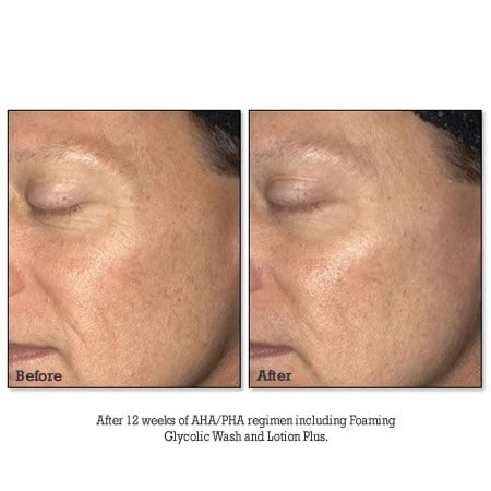 NEOSTRATA Lotion Plus (RESURFACE) (200 Ml / 6.8 Fl Oz) 6 NEOSTRATA Lotion Plus (RESURFACE) (200 Ml / 6.8 Fl Oz) - Image 4