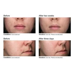 PCA Skin Acne Gel (1.0 Fl Oz / 29.5 Ml) -PureVita Store PCAV190277 BA