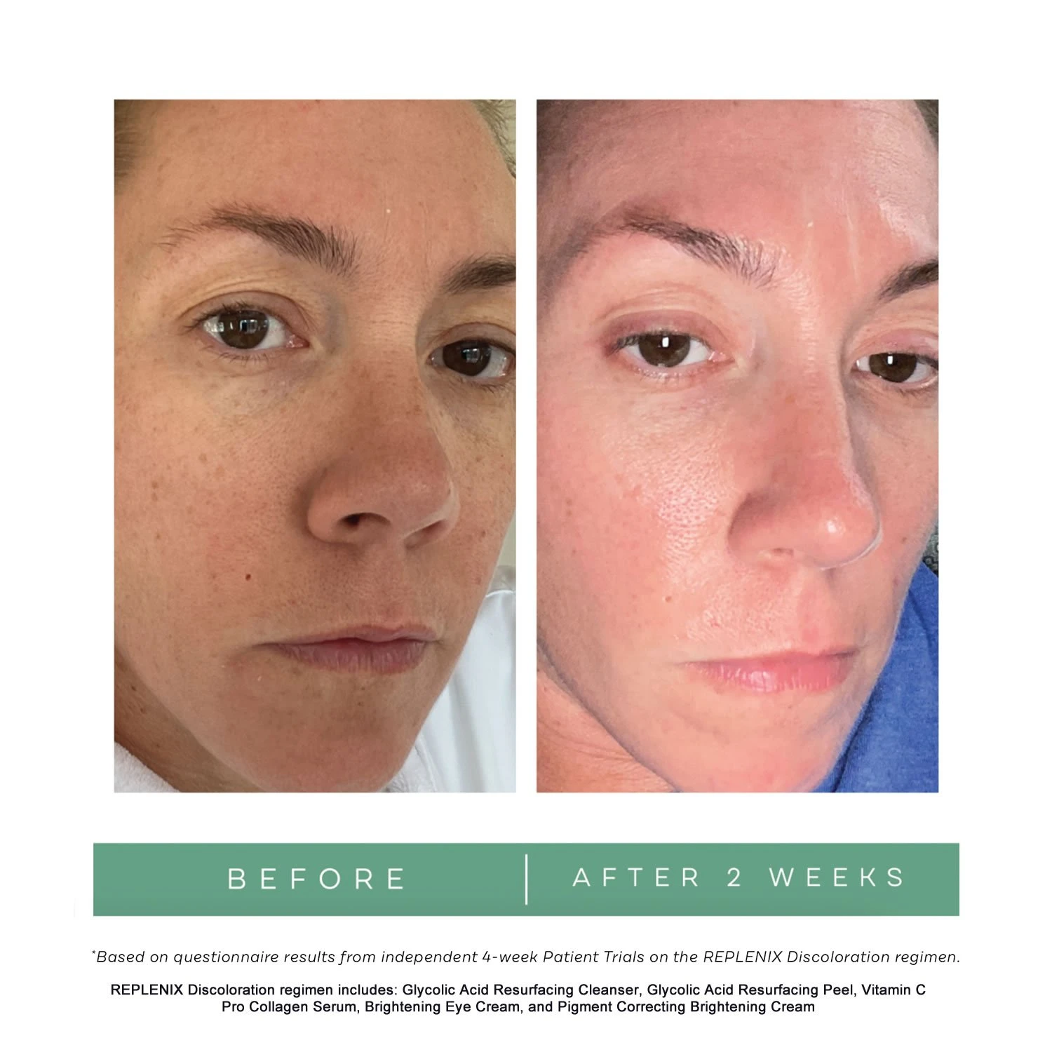 REPLENIX Glycolic Acid 10% Resurfacing Peel (formerly Known As Glycolix Elite Treatment Pads 10%) (60 Pads) 7 REPLENIX Glycolic Acid 10% Resurfacing Peel (formerly Known As Glycolix Elite Treatment Pads 10%) (60 Pads) - Image 5