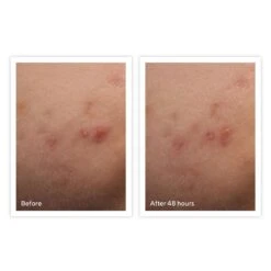 Murad Rapid Relief Acne Spot Treatment (Acne Control) (0.5 Fl Oz / 15 Ml) -PureVita Store murv131134 BA 48hrs