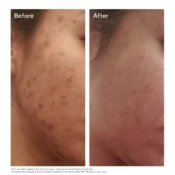 Murad Invisiscar Resurfacing Treatment (Acne Control) (0.5 Fl Oz) 11 Murad Invisiscar Resurfacing Treatment (Acne Control) (0.5 Fl Oz) -PureVita Store murv188511 BA