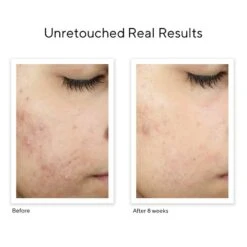 Murad Invisiscar Resurfacing Treatment (Acne Control) (0.5 Fl Oz) 9 Murad Invisiscar Resurfacing Treatment (Acne Control) (0.5 Fl Oz) -PureVita Store murv188511 BA1