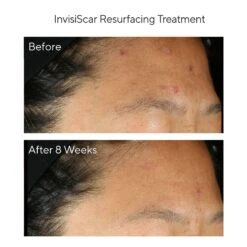 Murad Acne Control 30-Day Trial Kit (Acne Control) [$53 Value] (set) -PureVita Store murv190013 BA3