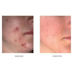 Vivier Acne Treatment System (set) ($138 Value) -PureVita Store stxv139479 BA3